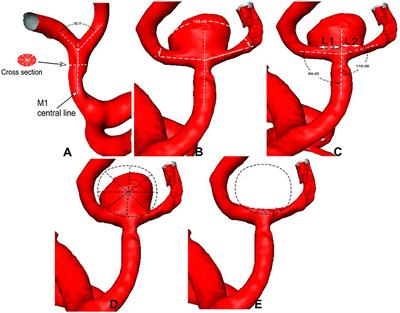 Greater hemodynamic stresses initiate aneurysms on major cerebral arterial bifurcations